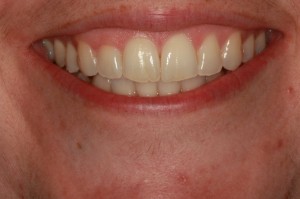 After Invisalign clear braces near Frenchtown