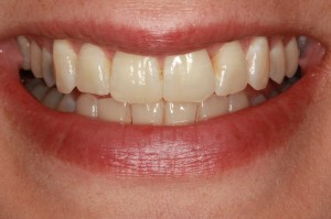 Missoula Invisalign patient after treatment