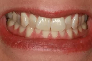 Invisalign patient of Missoula dentist Dr. Felton before treatment