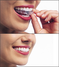 Invisalign clear braces for Lolo and Frenchtown