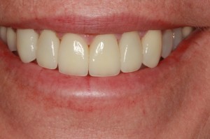 Image of a patient from Lolo's smile after receiving porcelain dental veneers in Missoula from Dr. Felton.